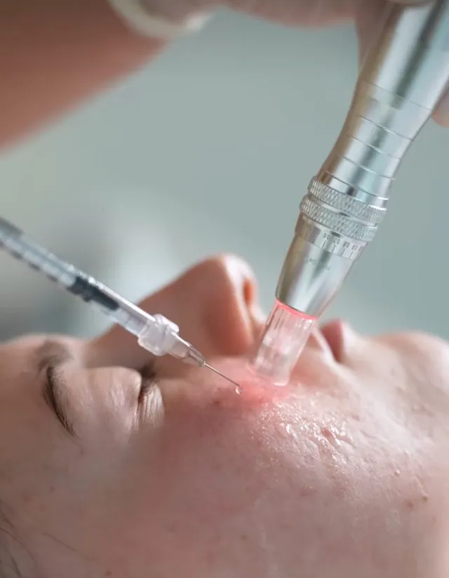 Microneedling - Hope Centar Beograd