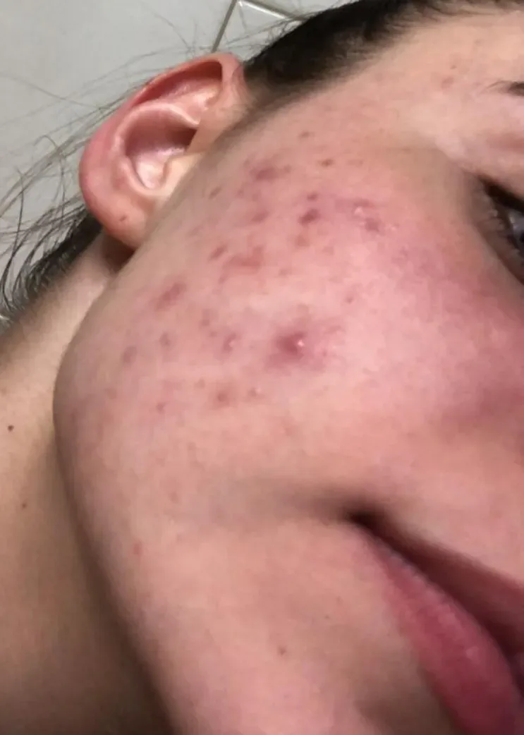 Pre