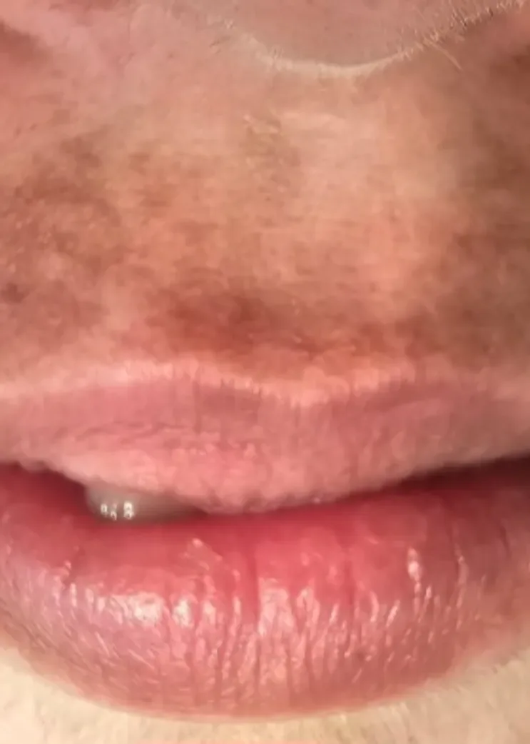 Pre