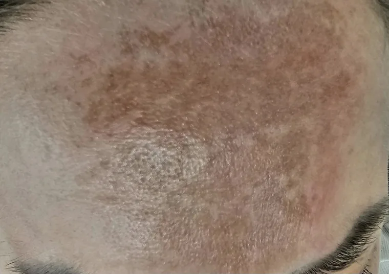 Pre